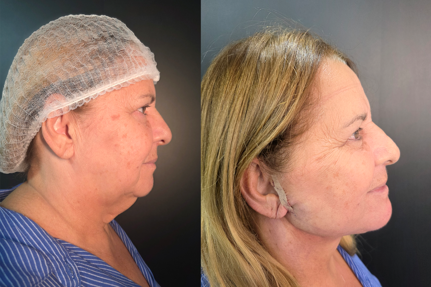cervicoplastia