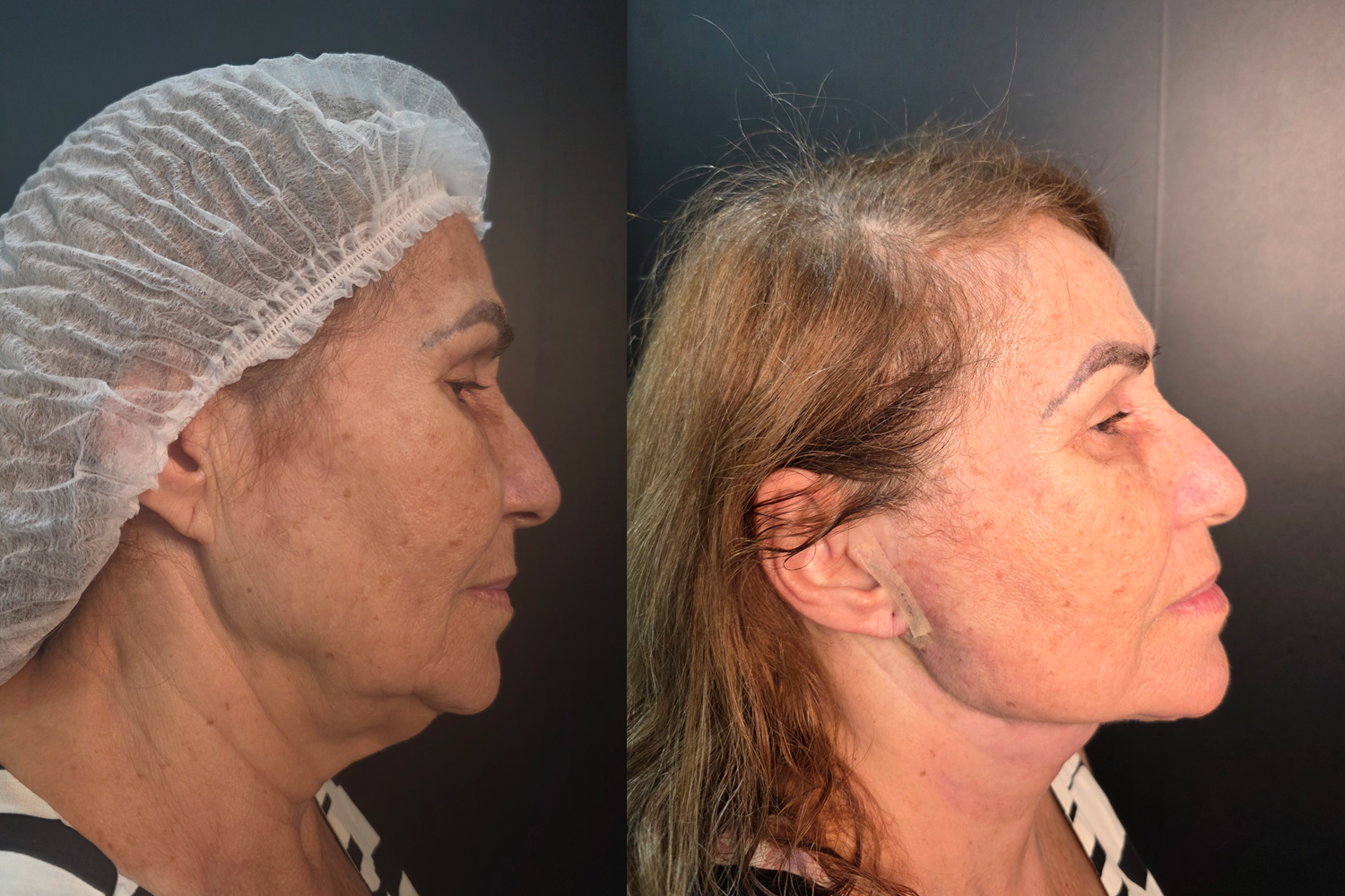 cervicoplastoa-bahia